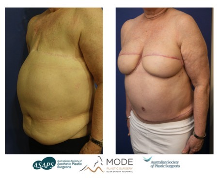 Breast reconstruction surgery results on woman who has suffered a double mastectomy