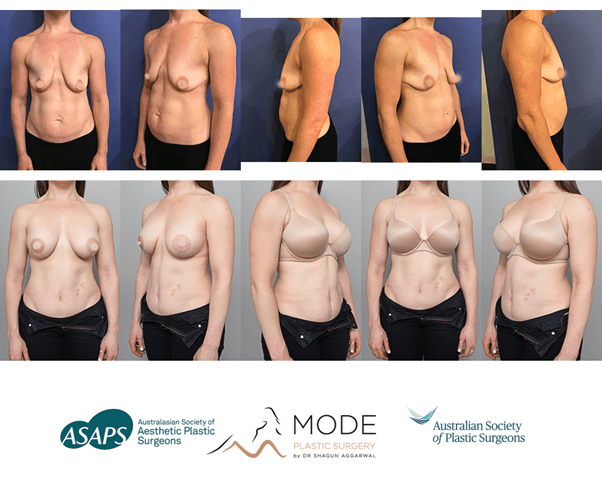 women before and after silicone breast implant surgery