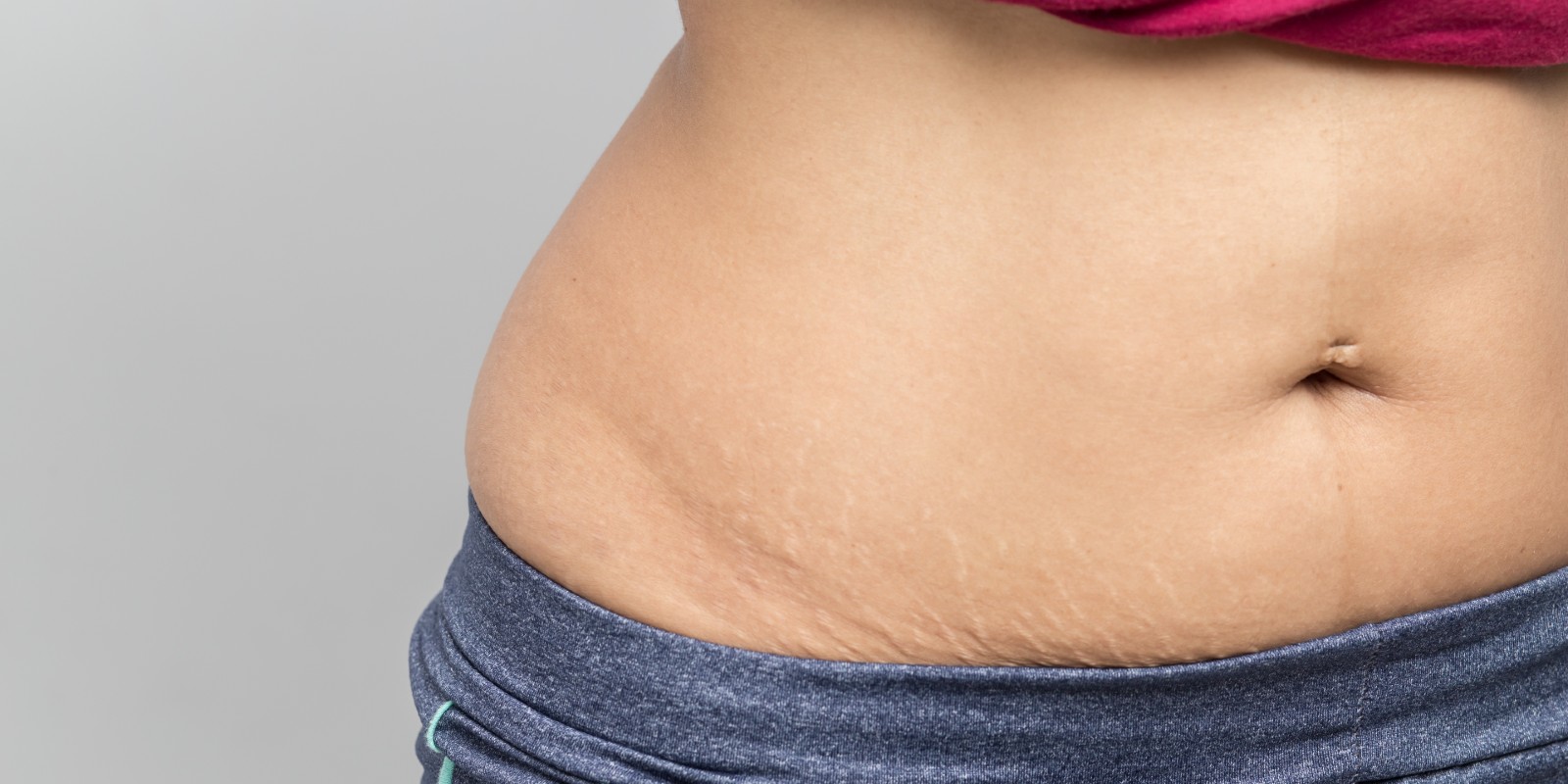 Tummy Tuck after Pregnancy