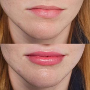Lip Filler Before & After - Front