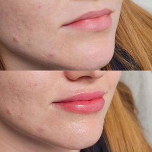 Lip Filler Before & After - Side